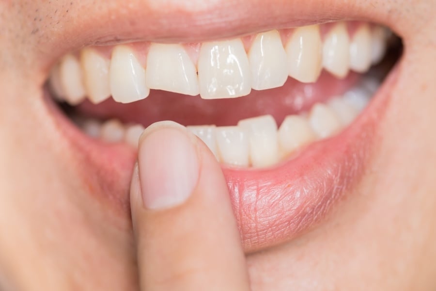 4 Effective Methods For Fixing A Chipped Tooth